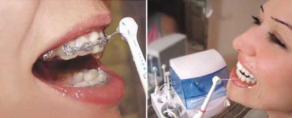  Using irrigator for braces