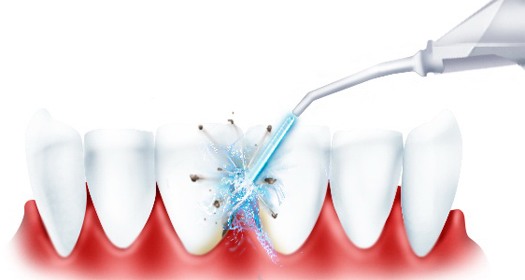  Oral Irrigator