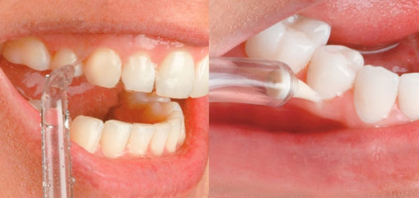  Oral Irrigator