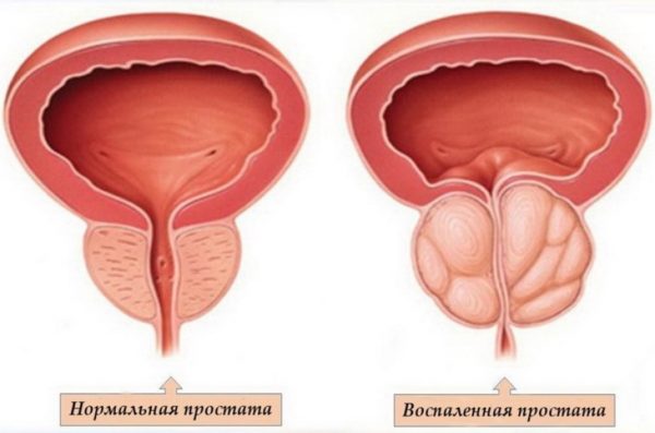  Prostate inflammation