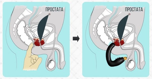  Prostate massager