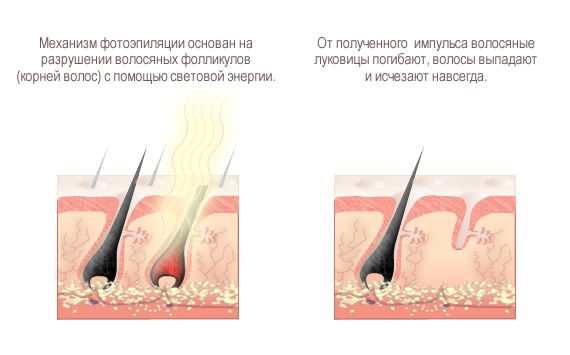  The principle of photoepilation