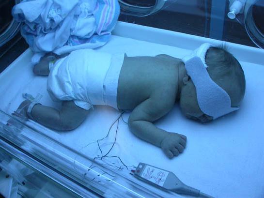  Premature baby under a quartz lamp