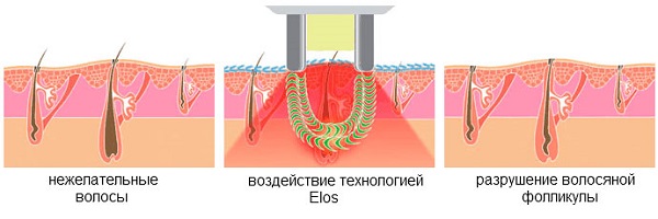  Elos Hair Removal Technology