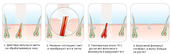  The principle of the photoepilator